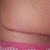 Right side 6 weeks PO