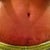8 Weeks PO, close up of my scar, getting ready to start silicone strip scar treatment