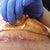 After 2 weeks from surgery I was healing very well and was put off meds. Unfortunately i had gotten an Infection 4 days after. Infection is getting better as I clean it and change bandages every day.