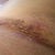 Left side, infection is better where drains were taken out incision is healing well.