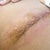 Right side, I believe I have dog ears it looks like a bulge of skin. I might have to get it redone