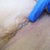 Cleaning the incision