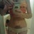7 weeks post op