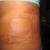 2 week PO. hematoma close up.