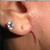 Right ear with Keloid