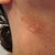 Scars on neck