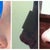 3D Consultation Pictures, Day of Surgery, Day of Cast Removal