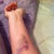 Week 1 IV impressive bruise