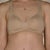 8 weeks post op