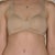 8 weeks post op