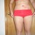 2 days post-op