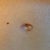 Notice the left side is lighter in color and the skin is wrinkly. From steroid injection.