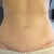 Scar at 13 weeks PO.