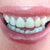 After redo crown lengthening with sutures. My gums now feel much less tender, the swelling has subsided and the bleeding has  almost stopped.