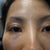 my left eye looking different from my right cause of the double fold