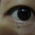 how my it looks like before surgery (right eye)