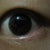 how my it looks like before surgery (left eye)