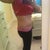 3 Months Post Op- Left Side View of Incision
