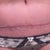 Wk 18 Scar with steristrips