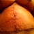 One week post-op