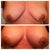 Before and 2nd day post op