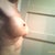 view of right breast from side.  I never had these veins showing until the implants were put in.