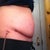 1 wk PO, side w/drain