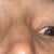 My eyelid has retraction and does not close all the way. Too much skin was removed on my left upper eyelid.