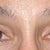 My eyes are very hollow due too much fat removed.