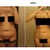 May 2012 - 4 Months Post Op