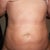 Two weeks post surgery
