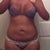 I week post op... I was super swollen! I couldn't even bend to put on my shoes