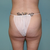 pre op butt