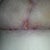 Concerned about the t-junction incision. Infected?
