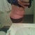 This is what it looks like when I bend over . . . not very attractive & it's uncomfortable (before surgery)