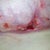 3 wks 2days  The day the PS removed the dead tissue from my T-junction separation on right breast.