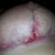 3 wks 5days Right breast separation
