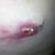 3 wks 5days Left side separation under armpit (where the drain tube was located).