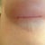 Look closely and you can see the 2 cords that showed up under my right boob. I can feel some on my left, too, but not as prominent. :(