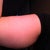 Right upper arm, 1 week prior to the procedure/
