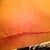 scar 7 weeks po