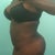 3 months post op