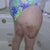 1 week post-op/thighs