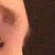 Right side before (worst side) - bulbous nostril and dorsal hump