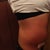Post op day week 2