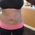 6 days after Smart Lipo {Stomach}