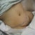 Immediately after.  Love my button and scar couldn't be more perfect!