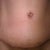 25 days after revision and before silicone treatment.