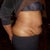 Stretch marks "galore"