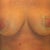 right breast had full lift, with no verticle inciscion scar, incision goes off the lower side off breast instead... I love it!!
